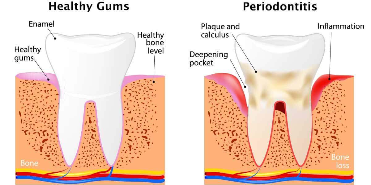 Healthy gums vs periodontitis graphic