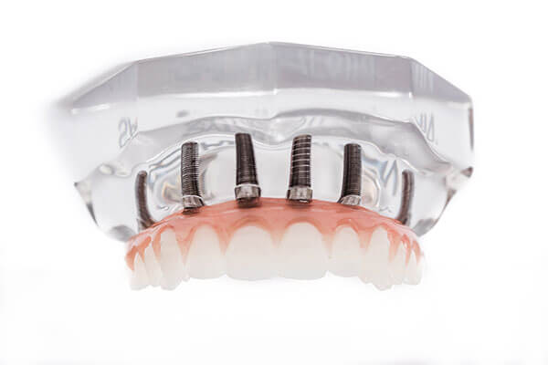 implant supported denture graphic