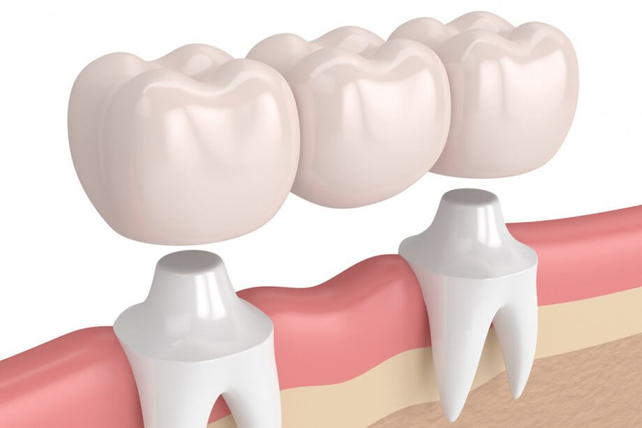 How Should a Dental Bridge Fit