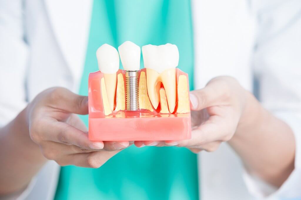 How to Clean Dental Implants Life Dental Specialties