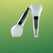 Dental Implants