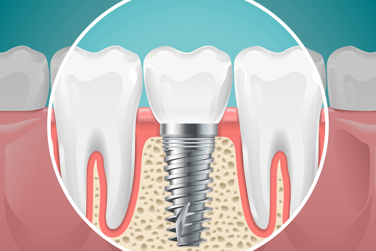 What is the All-on-4 Dental Implant?